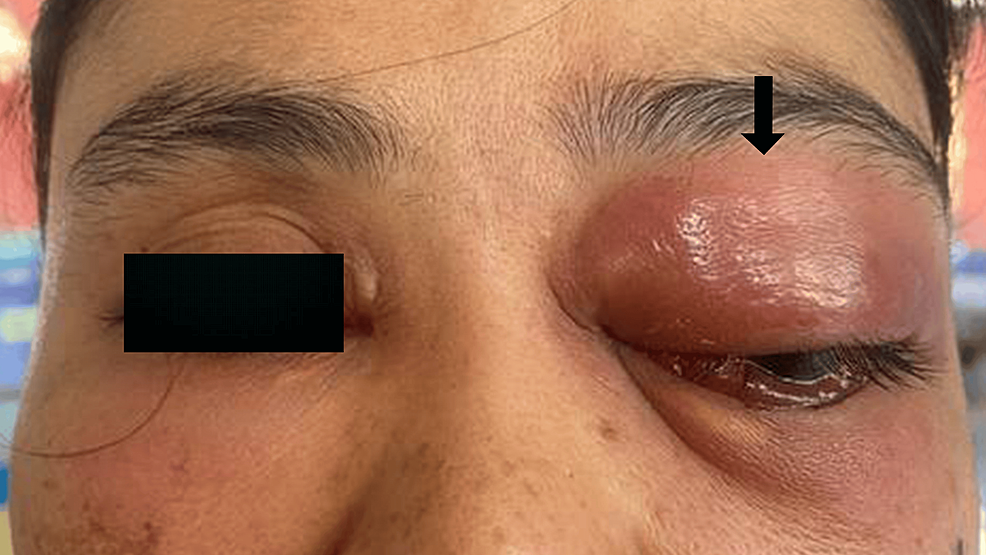 alergi yang bisa terjadi akibat sulam alis